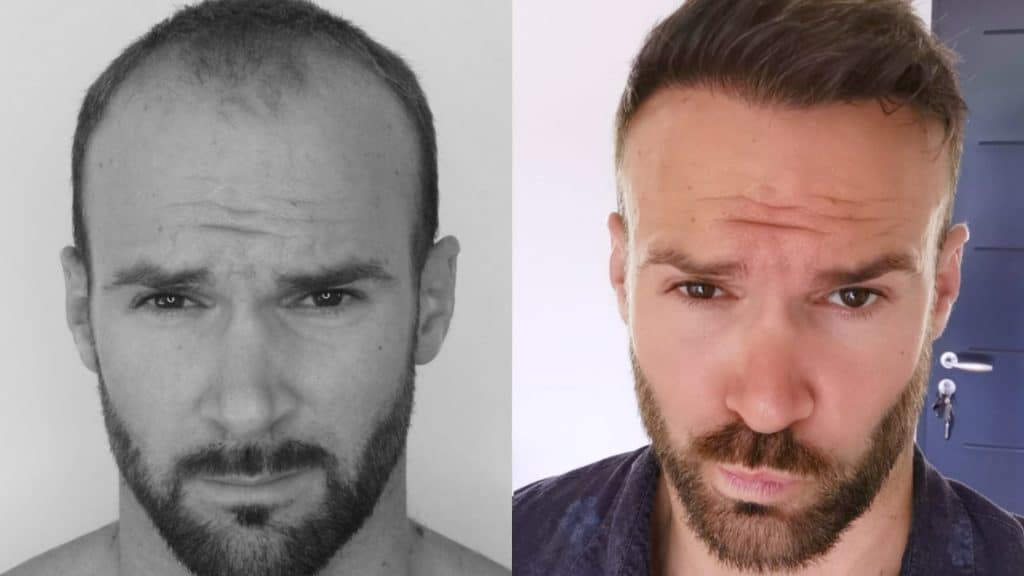 hair transplant before and after male