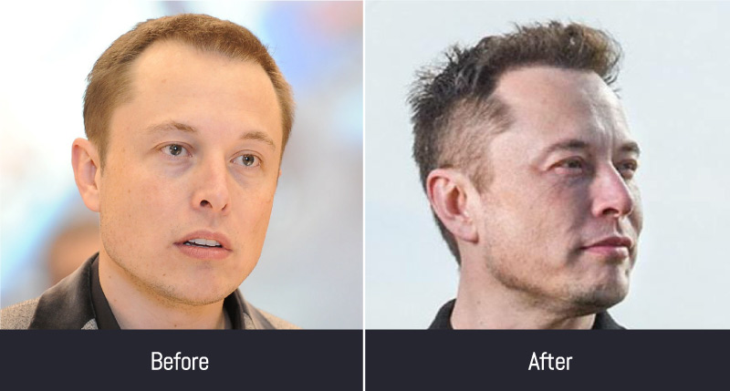 Elon Musk hair transplant before and after