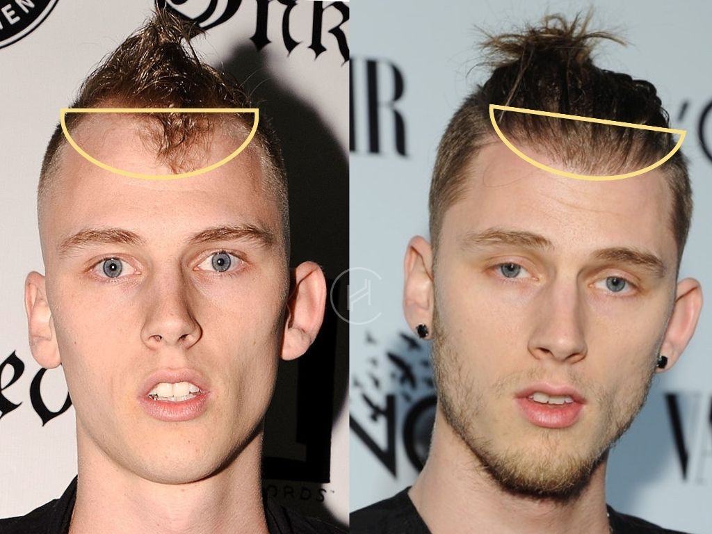 Machine Gun Kelly Before and After Hair Transplant