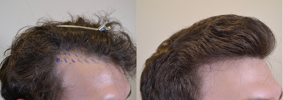 mens hair transplant before and after
