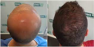 DHI Hair Transplant Before and After