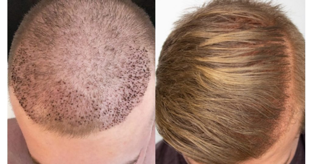 Hair transplant Houston Before and After