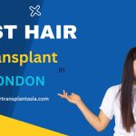 Best Hair Transplant in London